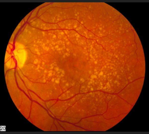 Retina Age Related Macular Degeneration
